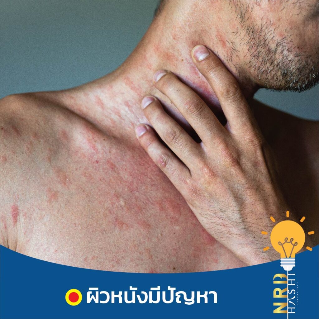 โรคที่มาพร้อมการ อดนอน